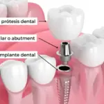 Precios de implantes dentales en Perú: Encuentra las mejores ofertas